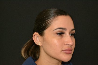 Rhinoplasty Before & After Patient #19855