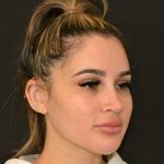 Rhinoplasty Before & After Patient #19855