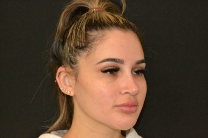 Rhinoplasty Before & After Patient #19855
