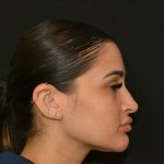 Rhinoplasty Before & After Patient #19855