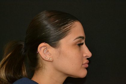 Rhinoplasty Before & After Patient #19855
