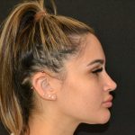 Rhinoplasty Before & After Patient #19855
