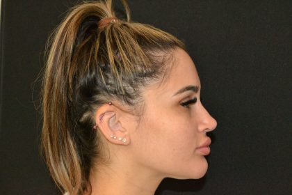 Rhinoplasty Before & After Patient #19855