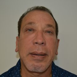 Rhinoplasty Before & After Patient #19841