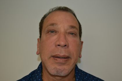 Rhinoplasty Before & After Patient #19841