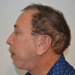 Rhinoplasty Before & After Patient #19841