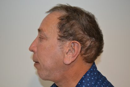 Rhinoplasty Before & After Patient #19841