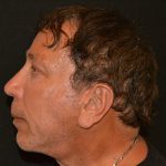 Rhinoplasty Before & After Patient #19841