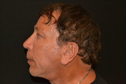 Rhinoplasty Before & After Patient #19841