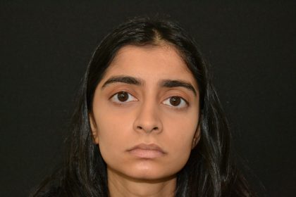 Rhinoplasty Before & After Patient #19856