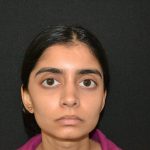 Rhinoplasty Before & After Patient #19856