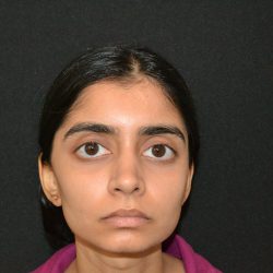 Rhinoplasty Before & After Patient #19856