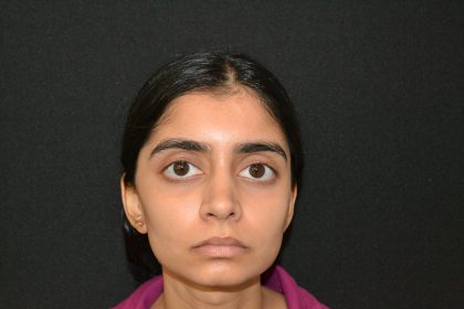 Rhinoplasty Before & After Patient #19856