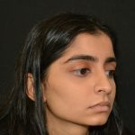 Rhinoplasty Before & After Patient #19856