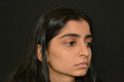 Rhinoplasty Before & After Patient #19856