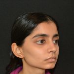 Rhinoplasty Before & After Patient #19856