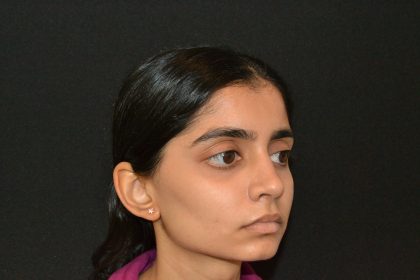 Rhinoplasty Before & After Patient #19856