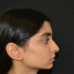 Rhinoplasty Before & After Patient #19856