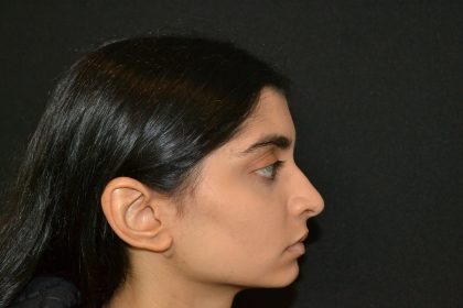 Rhinoplasty Before & After Patient #19856