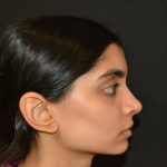 Rhinoplasty Before & After Patient #19856