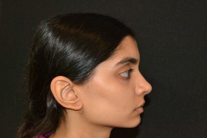 Rhinoplasty Before & After Patient #19856