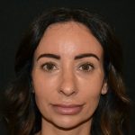 Rhinoplasty Before & After Patient #19857