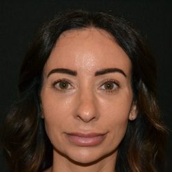 Rhinoplasty Before & After Patient #19857