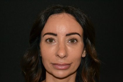 Rhinoplasty Before & After Patient #19857