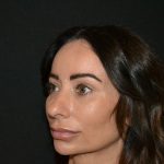 Rhinoplasty Before & After Patient #19857
