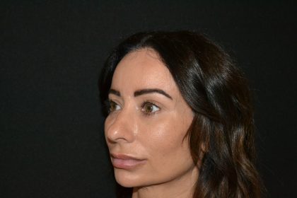 Rhinoplasty Before & After Patient #19857