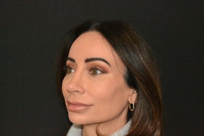 Rhinoplasty Before & After Patient #19857