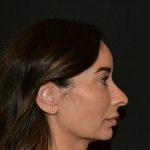 Rhinoplasty Before & After Patient #19857