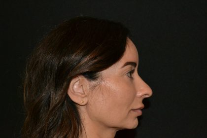 Rhinoplasty Before & After Patient #19857