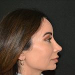 Rhinoplasty Before & After Patient #19857