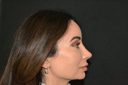 Rhinoplasty Before & After Patient #19857
