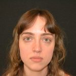 Rhinoplasty Before & After Patient #19858
