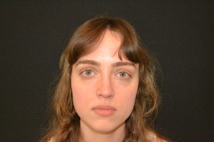 Rhinoplasty Before & After Patient #19858