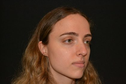 Rhinoplasty Before & After Patient #19858