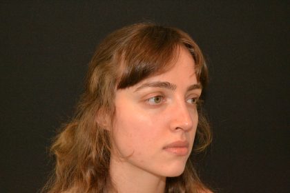 Rhinoplasty Before & After Patient #19858