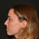 Rhinoplasty Before & After Patient #19858