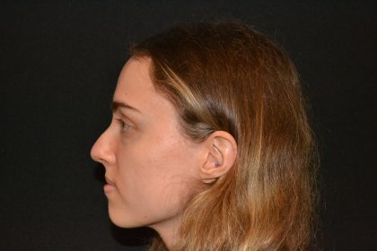 Rhinoplasty Before & After Patient #19858