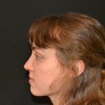Rhinoplasty Before & After Patient #19858