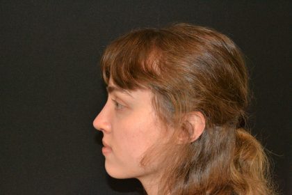 Rhinoplasty Before & After Patient #19858