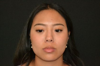 Rhinoplasty Before & After Patient #19860