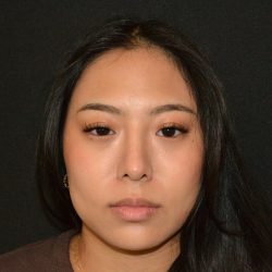 Rhinoplasty Before & After Patient #19860