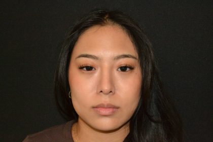 Rhinoplasty Before & After Patient #19860