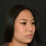 Rhinoplasty Before & After Patient #19860