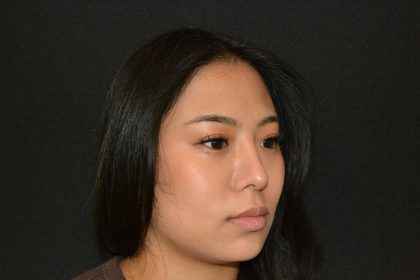 Rhinoplasty Before & After Patient #19860