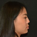 Rhinoplasty Before & After Patient #19860