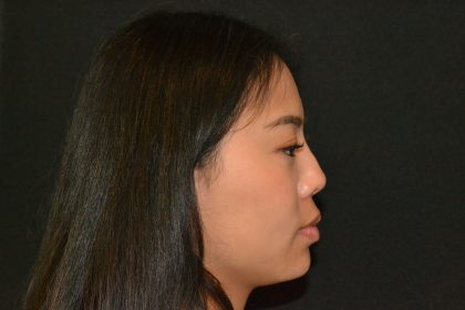 Rhinoplasty Before & After Patient #19860